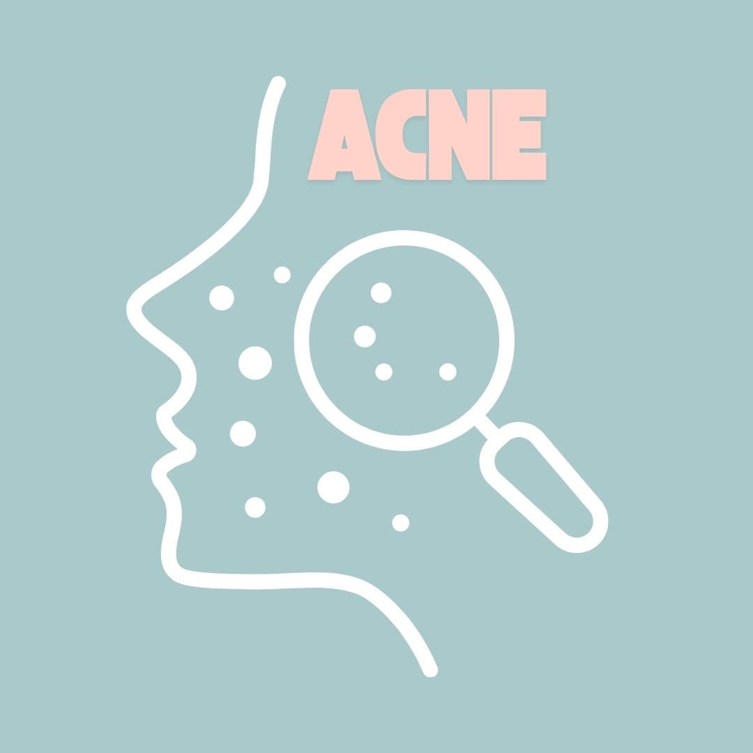 Featured image for Persistent Acne: Natural Treatments for Chronic and Cystic Acne